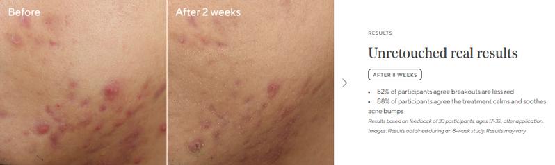 Murad Deep Relief Acne Treatment with 2% Salicylic Acid & Phytosteroid Technology for Severe Acne Healing & Skin Repair