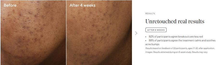 Murad Deep Relief Acne Treatment with 2% Salicylic Acid & Phytosteroid Technology for Severe Acne Healing & Skin Repair