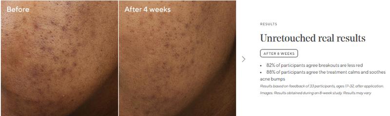 Murad Deep Relief Acne Treatment with 2% Salicylic Acid & Phytosteroid Technology for Severe Acne Healing & Skin Repair