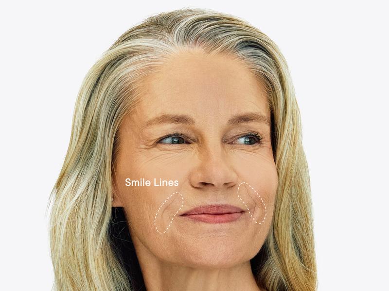 Qure Micro-Infusion Anti Wrinkle Patches for Smile Line, Frown lines, Under Eye Bags, Puffiness, Crow's Feet - Retinol, Niacinamide, Caffeine, Peptides - Dissolvable for Overnight Use - 8 Pairs