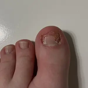 Lunavia Antifungal Pen - UNDECYLENIC ACID 25% - Cures Most Athlete’s Foot, Jock Itch, and Ringworm