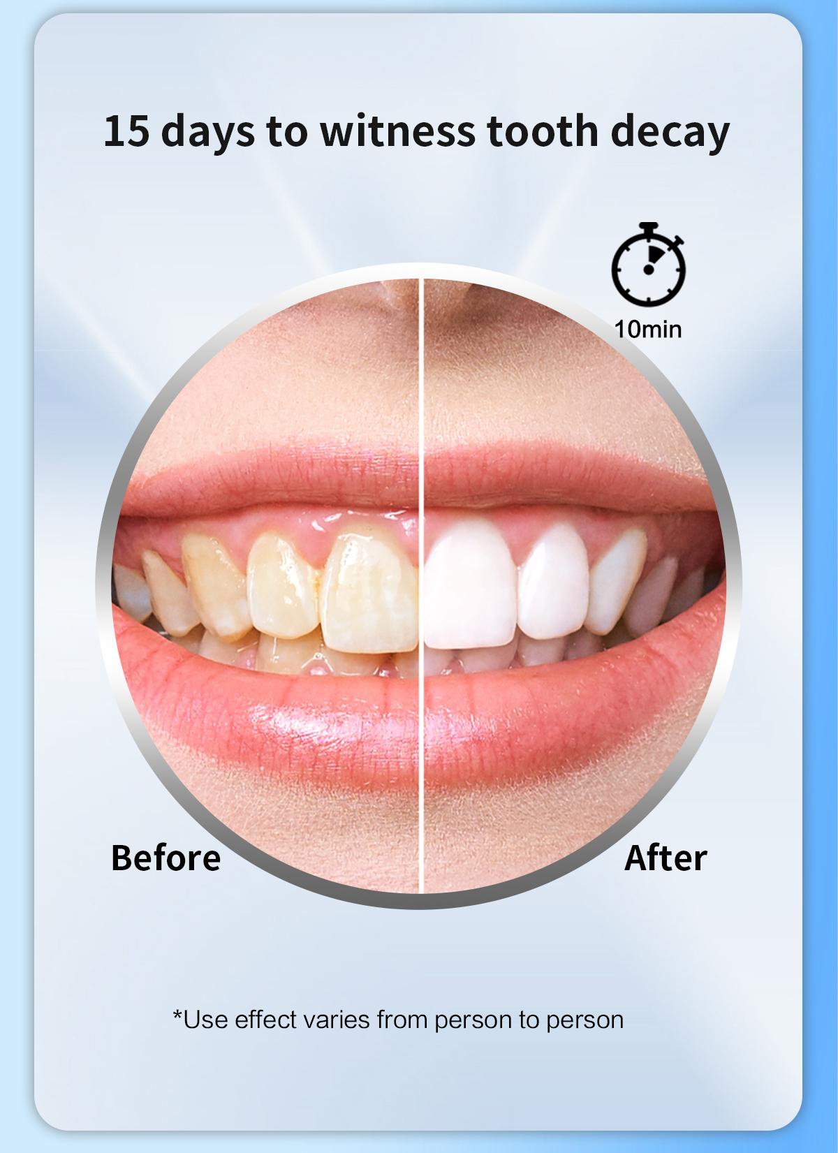MySmile Original Teeth Whitening Kit with LED Light (5x Bulbs) - 3 Gels for Sensitive Teeth | Fast 10-Min Results