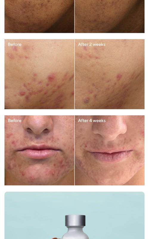 Deep Relief Acne Treatment 2-Pack