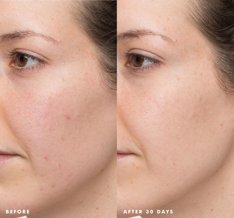 Comeback Clear Rapid Relief Acne Banishing Kit Skincare Repair Skin Repair Cleanser Facial