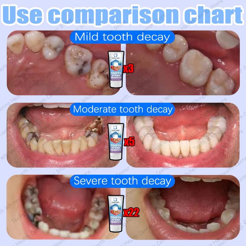 ZKRICARO Anti-Cavity Repair Toothpaste FDA Certified Cavity Repair Whitens Teeth Strengthens Enamel Relieves Sensitivity & Bad Breath