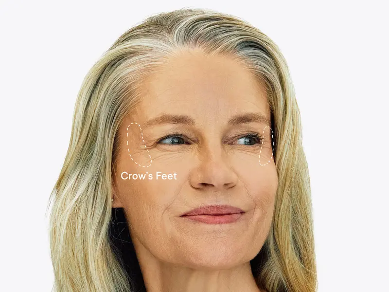 Product Introduction of Qure Micro-Infusion Anti Wrinkle Patches for Smile Line, Frown lines, Under Eye Bags, Puffiness, Crow's Feet - Retinol, Niacinamide, Caffeine, Peptides - Dissolvable for Overnight Use - 8 Pairs 11