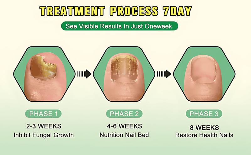 7-Day Nail Fungal Treatment Serum Foot Fungus Remedy Removal Products Anti infection Onychomycosis Paronychia Repair Gel Care Ginger Healthcare Therapeutic Therapy Bathroom Solution nailgrowthoil Healthy Wellness Aid Liquid Fitness Organic Skin Ginkgo