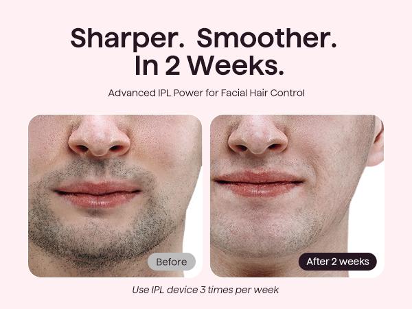 Wavytalk Bare It IPL Hair Removal with Ice Cooling, 3 Modes & 24J Dual-Pulse for Salon-Level Results on Face, Body & Bikini, Painless & Precise