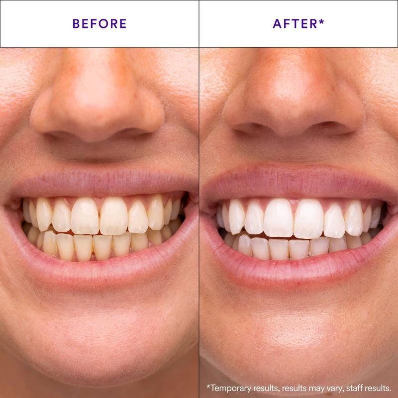 Hismile V34 Whitening Strips, Teeth Whitening Strips, Purple Tooth Whitening, Tooth Stain Treatment, Combining Whitening and Colour Correction Hismile V34 Whitening Strips, Teeth Whitening Strips, Purple Tooth Whitening, Tooth Stain Treatment, Combining Whitening and Colour Correction