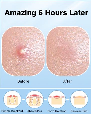 QUSTERE Pimple Patches for Face, Hydrocolloid Acne Patches, Cute Star Zit Covers, Colorful Spot Stickers with Tea Tree, Salicylic Acid & Cica Oil| 3 Sizes (10mm, 12mm & 14mm) |200 Count Skincare Skin Repair