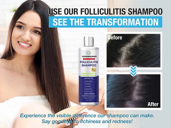 PHARMBANNER Anti-Fungal Shampoo – Relief for Folliculitis, Seborrheic Dermatitis & Scalp Psoriasis | Soothes Itchy, Dry Scalp | 8.4 oz PHARMBANNER Anti-Fungal Shampoo – Relief for Folliculitis, Seborrheic Dermatitis & Scalp Psoriasis | Soothes Itchy, Dry Scalp | 8.4 oz