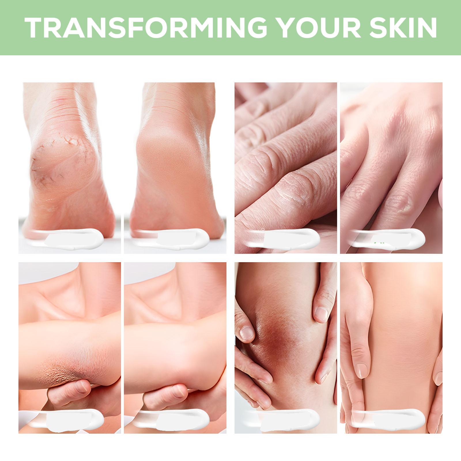 Urea Cream 40% plus Salicylic Acid 2% - Maximum Strength for Dry, Cracked Feet and Hands - Moisturizes and Softens  Hydrating Exfoliating Skin Friendly Moisturizer Hyaluronic Moisturizing Moisture Hydrate Nails