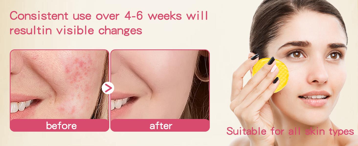 ISTON Turmeric Kojic Acid Cleansing Pads 100Pcs with Olive Oil Hylunaric Acid & Niacinamide for Face & Body Exfoliate Turmeric Cleansing Pads for Dark Spots Balance Skin Water & Oil Anti Wrinkle Scrubs Cleanser