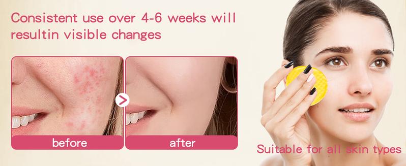 ISTON Turmeric Kojic Acid Cleansing Pads 100Pcs with Olive Oil Hylunaric Acid & Niacinamide for Face & Body Exfoliate Turmeric Cleansing Pads for Dark Spots Balance Skin Water & Oil Anti Wrinkle Scrubs Cleanser