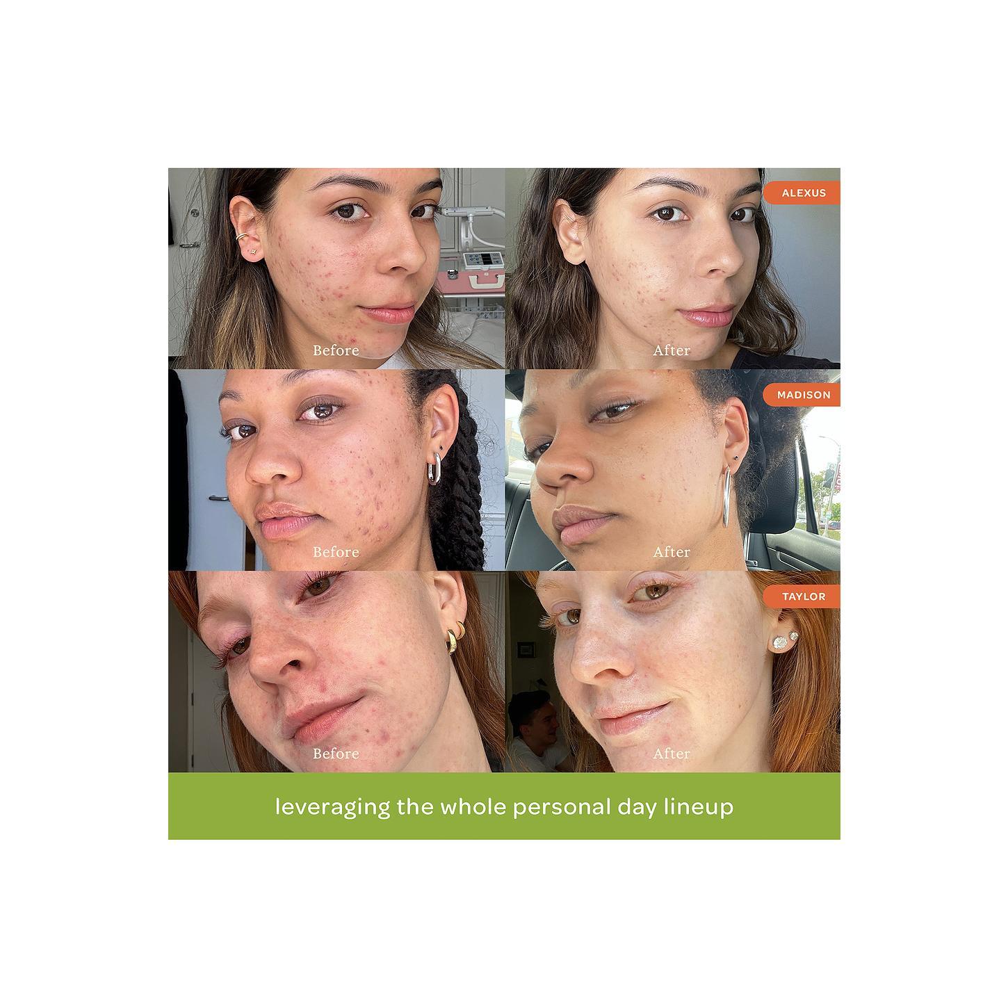 Personal Day Self-Discovery Skin Care Kit, Lactic Acid Cleanser for Acne Repair & Moisture Boosting Personal Day Self-Discovery Skin Care Kit, Lactic Acid Cleanser for Acne Repair & Moisture Boosting