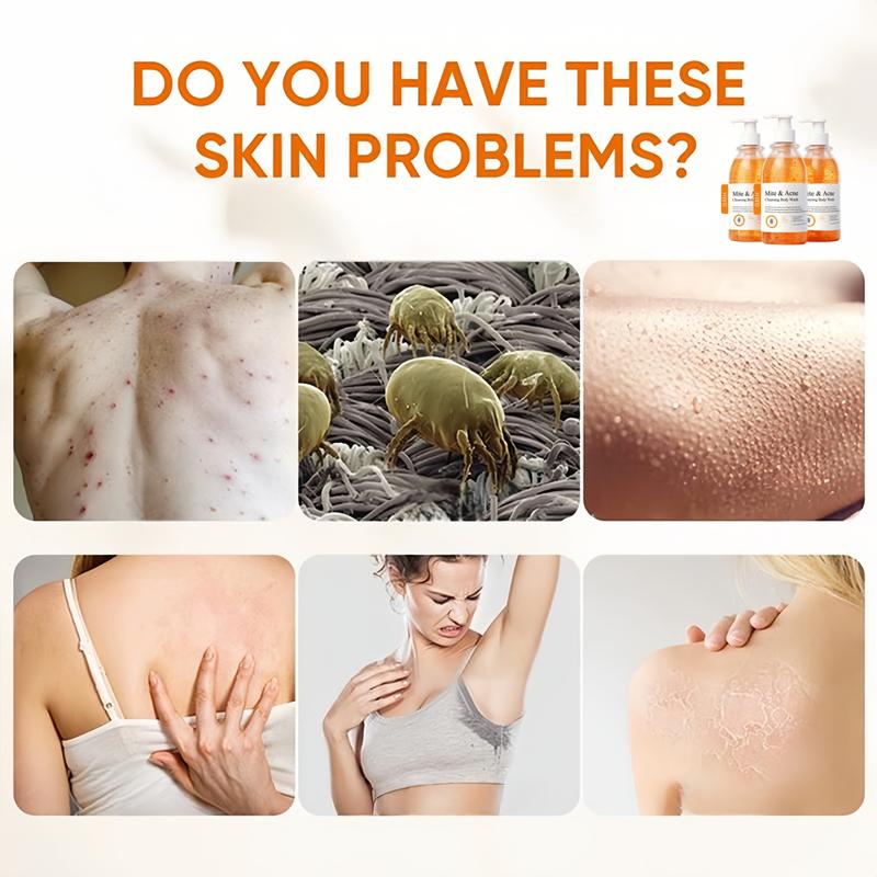 3 Pcs Mite & Acne Cleansing Body Wash Set- Anti-mite and Bacterial Cleansing Shower Gel, Gentle Plant Extracts Body Wash, Body Wash For Troubled Skin, Uneven Skin, Body Care Set