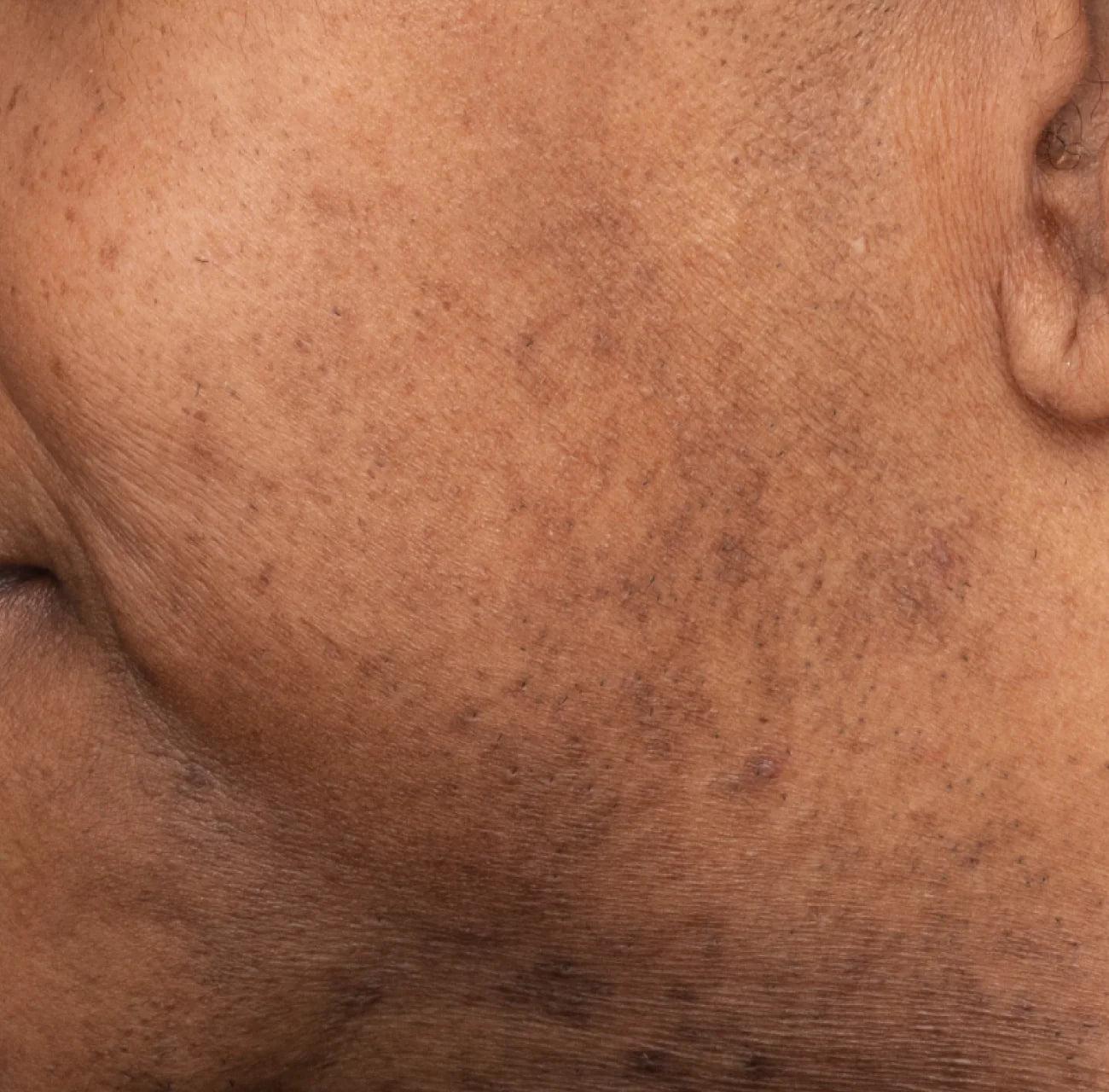 Major Fade Discoloration Duo - Daily Serum & Vitamin C Hydrating Moisturizer for Fading all Types of Discoloration Major Fade Discoloration Duo - Daily Serum & Vitamin C Hydrating Moisturizer for Fading all Types of Discoloration