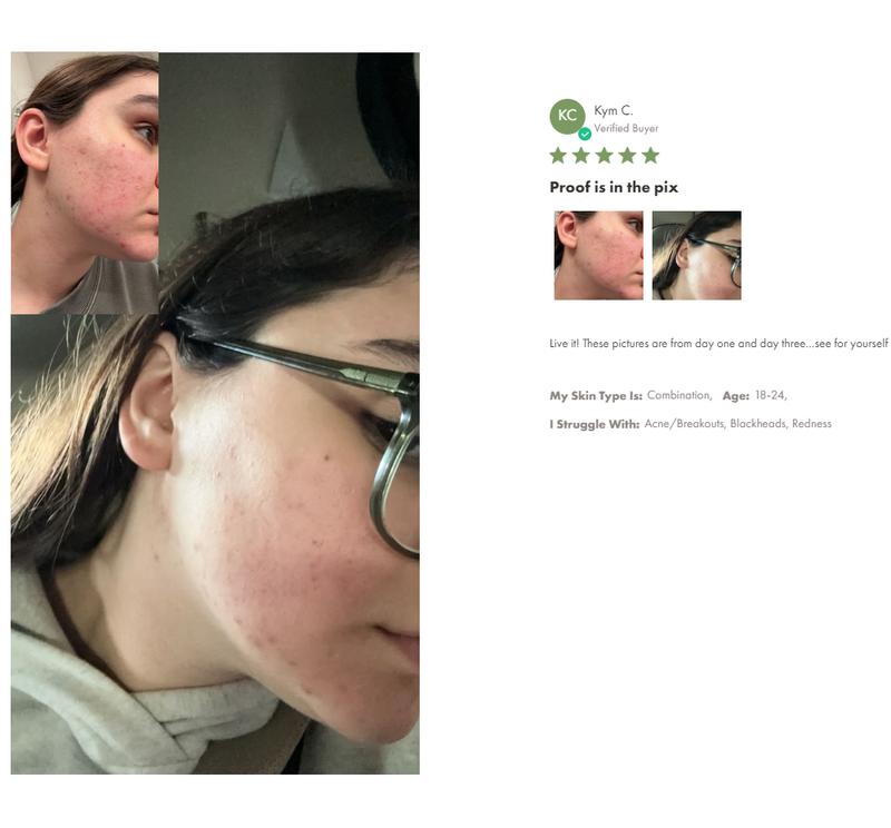 Comeback Clear Rapid Relief Acne Banishing Kit Skincare Repair Skin Repair Cleanser Facial