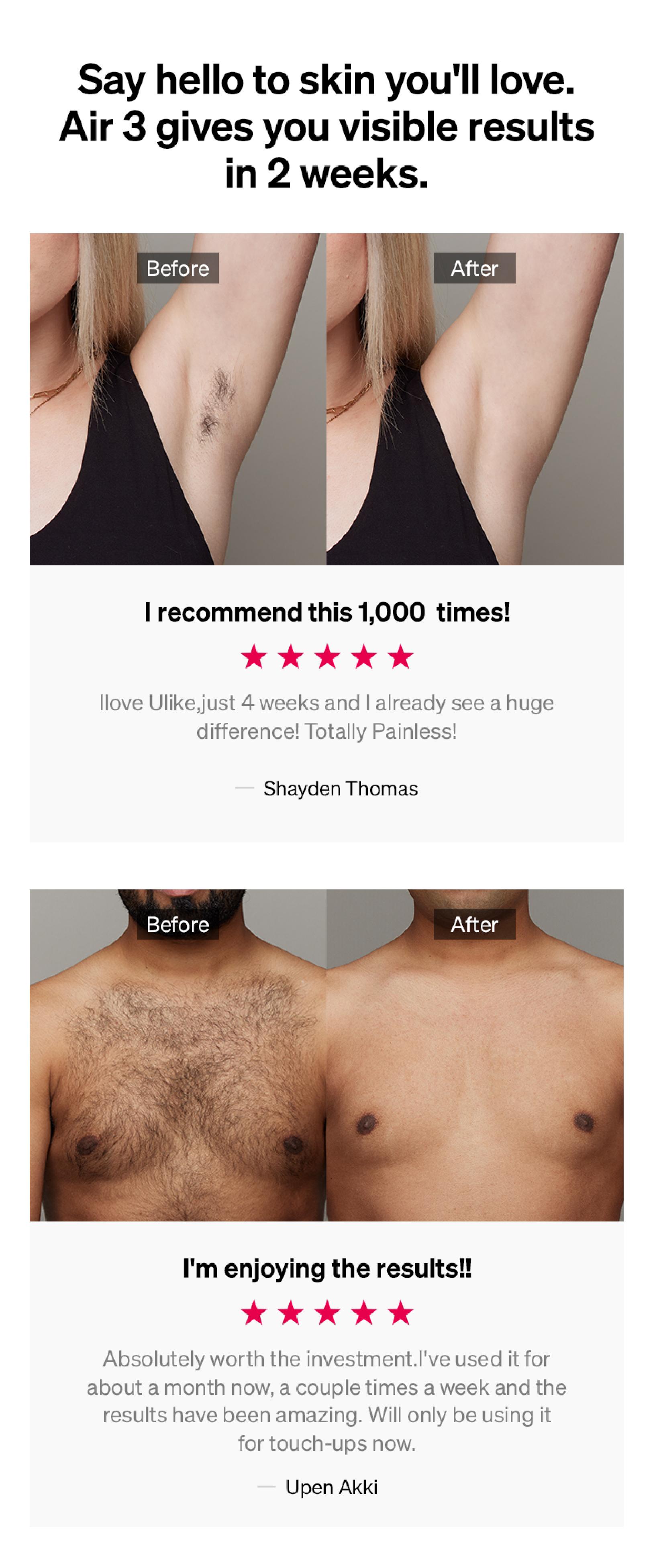 Ulike Air 3 IPL Hair Removal Device Ice-Cooling Contact & Skin Sensor for Women Men 90% Hair Reduction in 4 Weeks Comfortable Effective Hair Remover Springtok Depilator