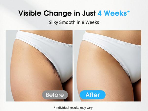 IPL Hair Removal Device LYSMOSKI KA10  with Cooling, 3-in-1 At-Home Laser Device - 9 Levels, 999900 Flashes for Women and Men, for Face, Armpit, Arm, Bikini Line, Leg, and Whole Body - Permanent Hair Removal Upgrade