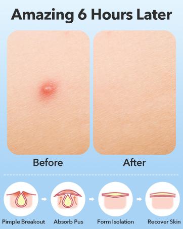 QUSTERE Pimple Patches for Face, Hydrocolloid Acne Patches, Cute Round Shape Zit Covers, Spot Stickers with Tea Tree, Salicylic Acid & Cica Oil| 2 Sizes (9mm, 12mm) |288 Count Skincare Clear QUSTERE Pimple Patches for Face, Hydrocolloid Acne Patches, Cute Round Shape Zit Covers, Spot Stickers with Tea Tree, Salicylic Acid & Cica Oil| 2 Sizes (9mm, 12mm) |288 Count Skincare Clear