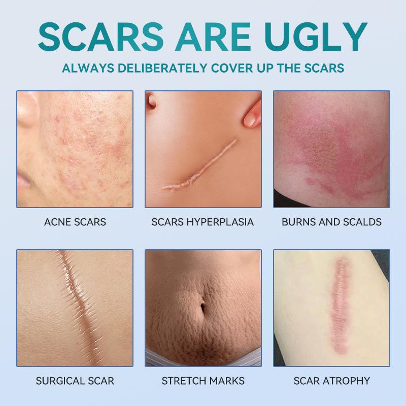 Professional Scar Removal Gel- Scarremoval treatment for keloids, C-sectionS, surgeries, burns, acne andmore.