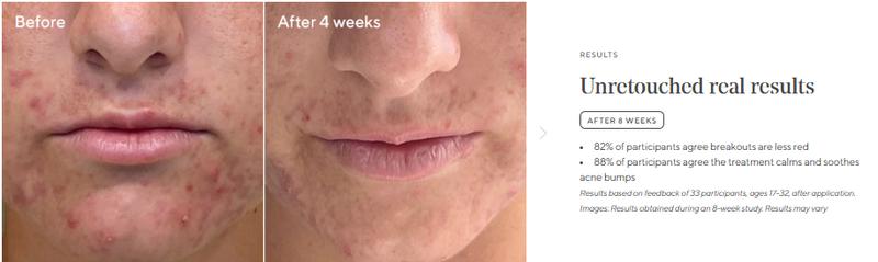 Murad Deep Relief Acne Treatment with 2% Salicylic Acid & Phytosteroid Technology for Severe Acne Healing & Skin Repair