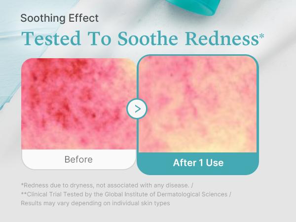 Azelaic Acid Gummy Whip Cleanser | Cleansing Foam For Troubled Skin | Use After Spot Care & Excess Sebum Control | Niacinamide, Glycerin | Soothing, Pore Cleansing Face Wash | Korean Skincare Azelaic Acid Gummy Whip Cleanser | Cleansing Foam For Troubled Skin | Use After Spot Care & Excess Sebum Control | Niacinamide, Glycerin | Soothing, Pore Cleansing Face Wash | Korean Skincare