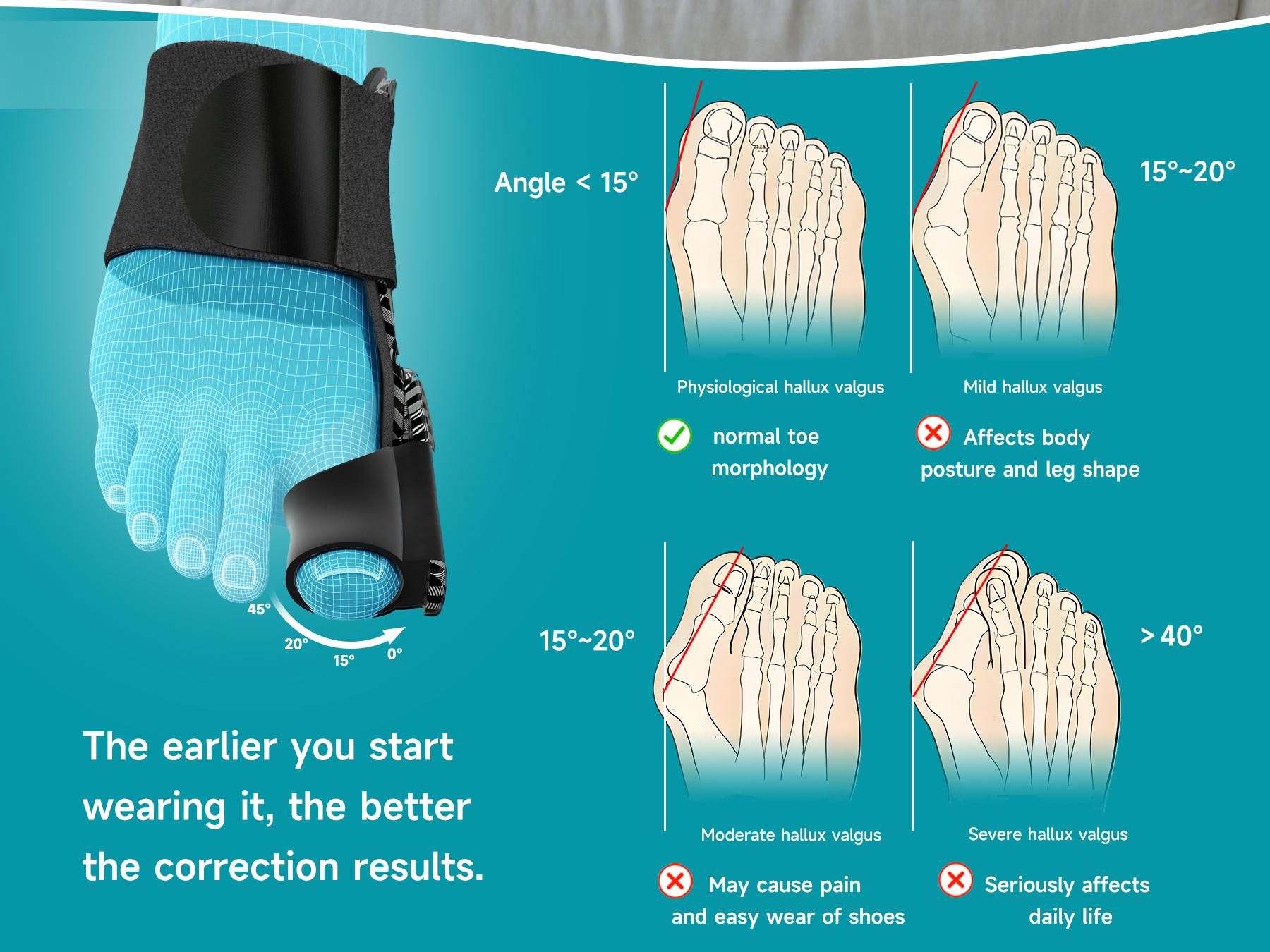 Bunion Corrector for Women Men Big Toe: Auto-Adaptive Bunion Relief for Big Toe Straightener - Orthopedic Bunion Splint for Pain Relief - Hallux Valgus Correction for Day/Night Support