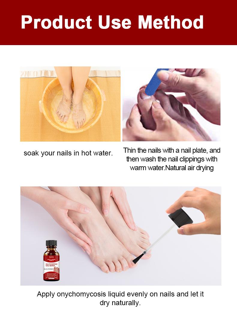 SOVS Toenail Fungus Treatment Extra Strength ,Antifungal Solution ,Triple Action Formula for Damaged Nails, Multi-Purpose Nail Repair,1 Fl Oz Manicure Therapy