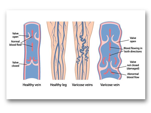 Vein Support Supplements Venease by PUREHEALTH RESEARCH - Natural Blood Circulation Supplement  - with Horse Chestnut Extract, Rutin & Buthers Broom Extract, 60 Capsules