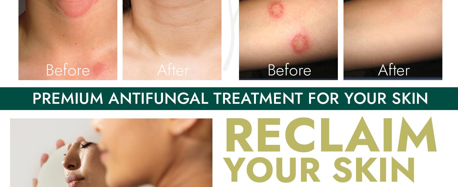 Antifungal Soap | Medicated Jock Itch Treatment, Fights Ringworm & Athlete's Foot | Soothing Tea Tree & Eucalyptus | 1% Tolnaftate for Effective Relief | Travel-Friendly with Soap Case