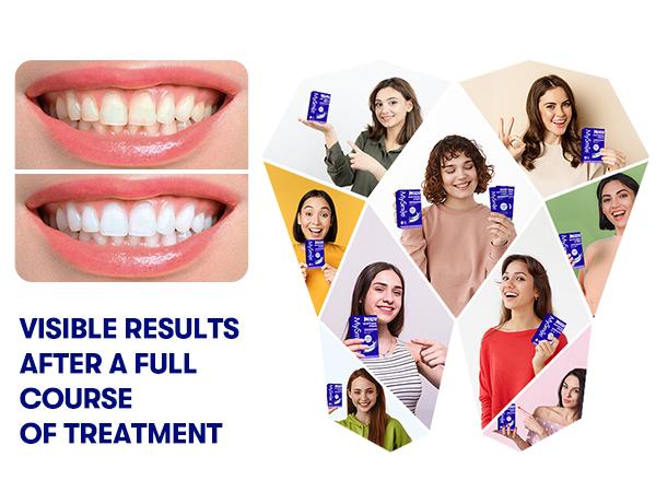 MySmile Non-Slip Teeth Whitening Strips - Enamel Safe & Sensitivity Free - Not Purple Strip(7/14/21 Treatments)