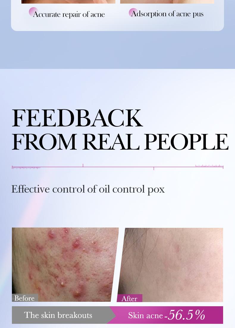 【156PCS】Star Shaped Hydrocolloid Acne Patch,Suitable for All Skin Types,Waterproof Acne Cover Patches, Repair and cover acne blemishes,Blemish Patches,Alcohol-Free Sensitive