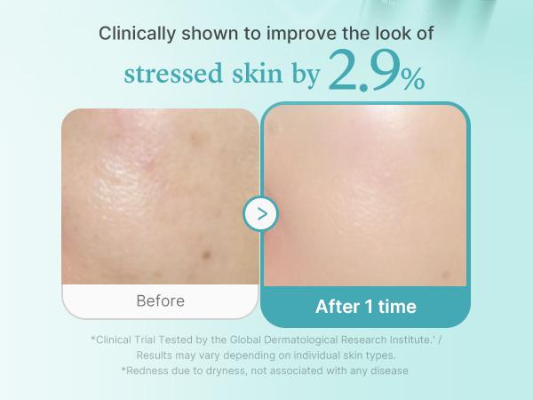 [NEW] medicube Azelaic Acid Exosome Shot 2000/7500 - Lightweight Formula for Comfortable, Healthy-Looking Skin