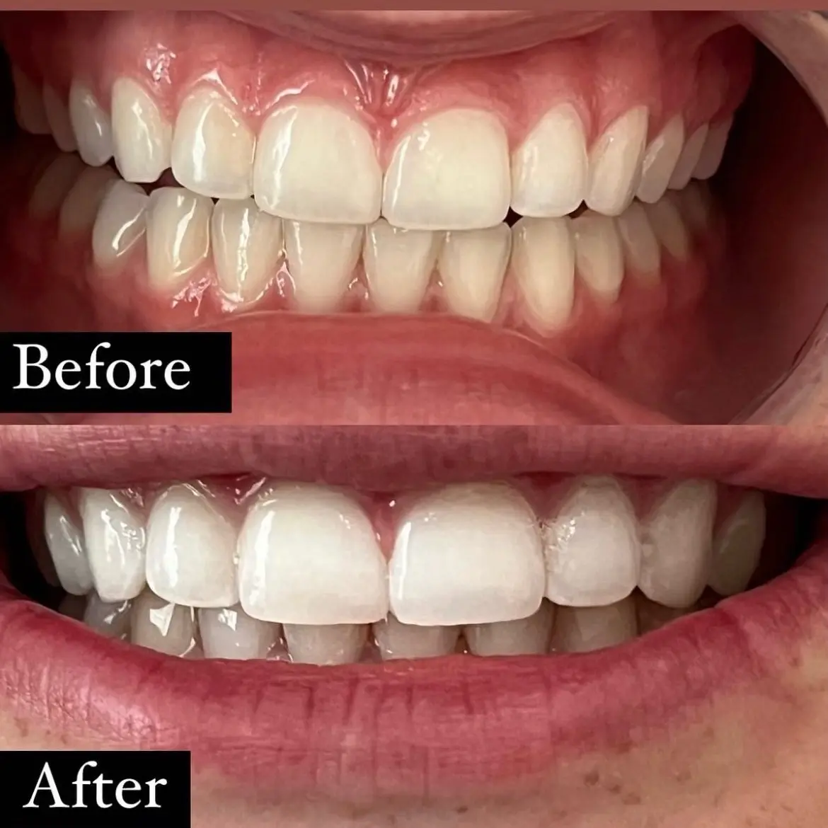 Teeth whitening pens! Instant results