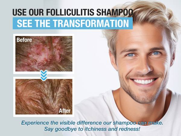 PHARMBANNER Anti-Fungal Shampoo – Relief for Folliculitis, Seborrheic Dermatitis & Scalp Psoriasis | Soothes Itchy, Dry Scalp | 8.4 oz PHARMBANNER Anti-Fungal Shampoo – Relief for Folliculitis, Seborrheic Dermatitis & Scalp Psoriasis | Soothes Itchy, Dry Scalp | 8.4 oz