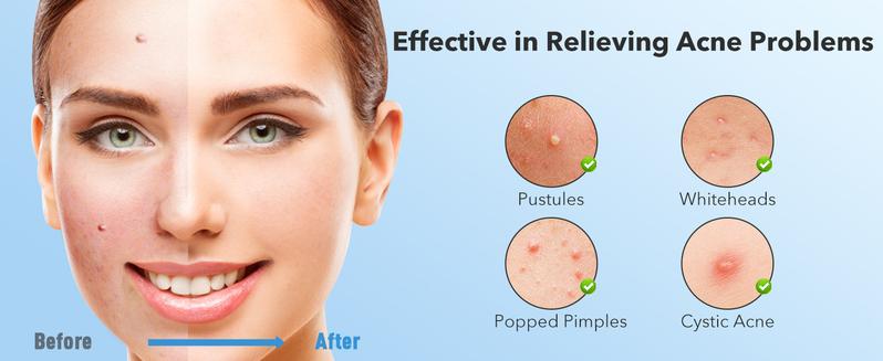 QUSTERE Pimple Patches for Face, Hydrocolloid Acne Patches, Cute Round Shape Zit Covers, Spot Stickers with Tea Tree, Salicylic Acid & Cica Oil| 2 Sizes (9mm, 12mm) |288 Count  Skincare Clear