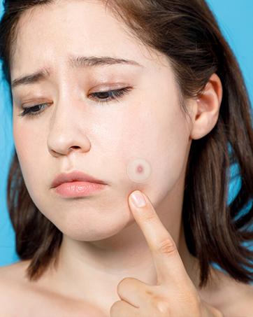 Advanced Hydrocolloid Healing Roll Patch – Medical Grade Invisible Acne & Pimple Patch Tape, Fast Skin Recovery Patch, Waterproof & Absorbent Wound Care Bandage (2in×13ft) Scar Treatment & Skin Repair