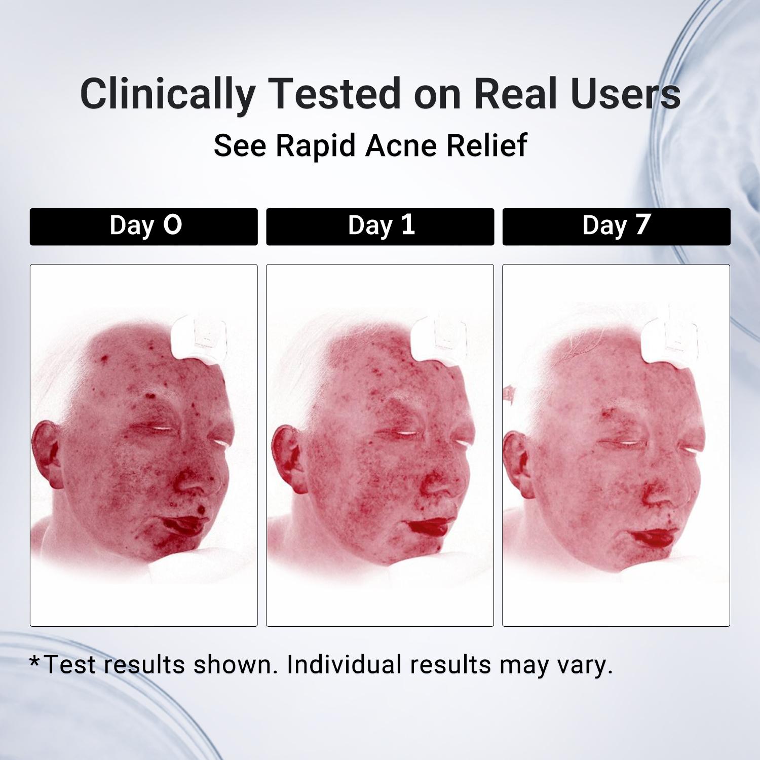 Dr.Leo Drying Lotion Plus – Fast-Acting Acne Spot Treatment | Reduce Pimples & Dark Marks, Oil Control & Anti-Inflammatory (20ml)