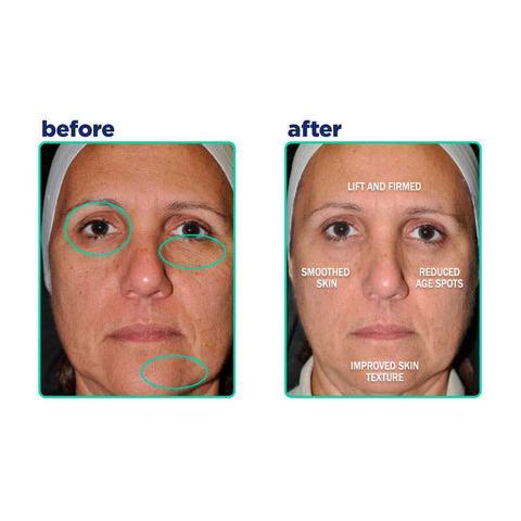 Skin Kick Renew Kick Duo: Clinically Proven Skincare to Fade Acne Scars & Revive Sensitive, Aging Skin