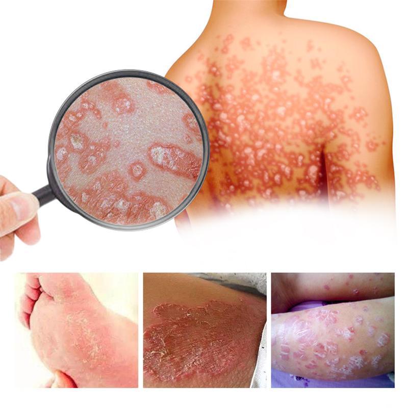 Powerful Antifungal Cream—Results in 7 Days—Effective for Psoriasis, Eczema, Ringworm, Jock Itch, Athlete's Foot, Onychomycosis, and Herpes—100% Natural Botanical Formula—Rapid Itch Relief, Prevents Recurrence, Repairs Dry, Cracked Skin Body Care Cream Powerful Antifungal Cream—Results in 7 Days—Effective for Psoriasis, Eczema, Ringworm, Jock Itch, Athlete's Foot, Onychomycosis, and Herpes—100% Natural Botanical Formula—Rapid Itch Relief, Prevents Recurrence, Repairs Dry, Cracked Skin Body Care Cream