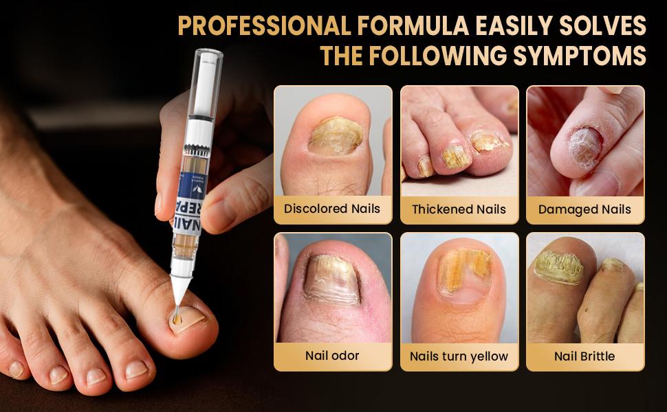 VecNythra Pen 25% Undecylenic Acid Helps Support Stronger Healthier-Looking Nails