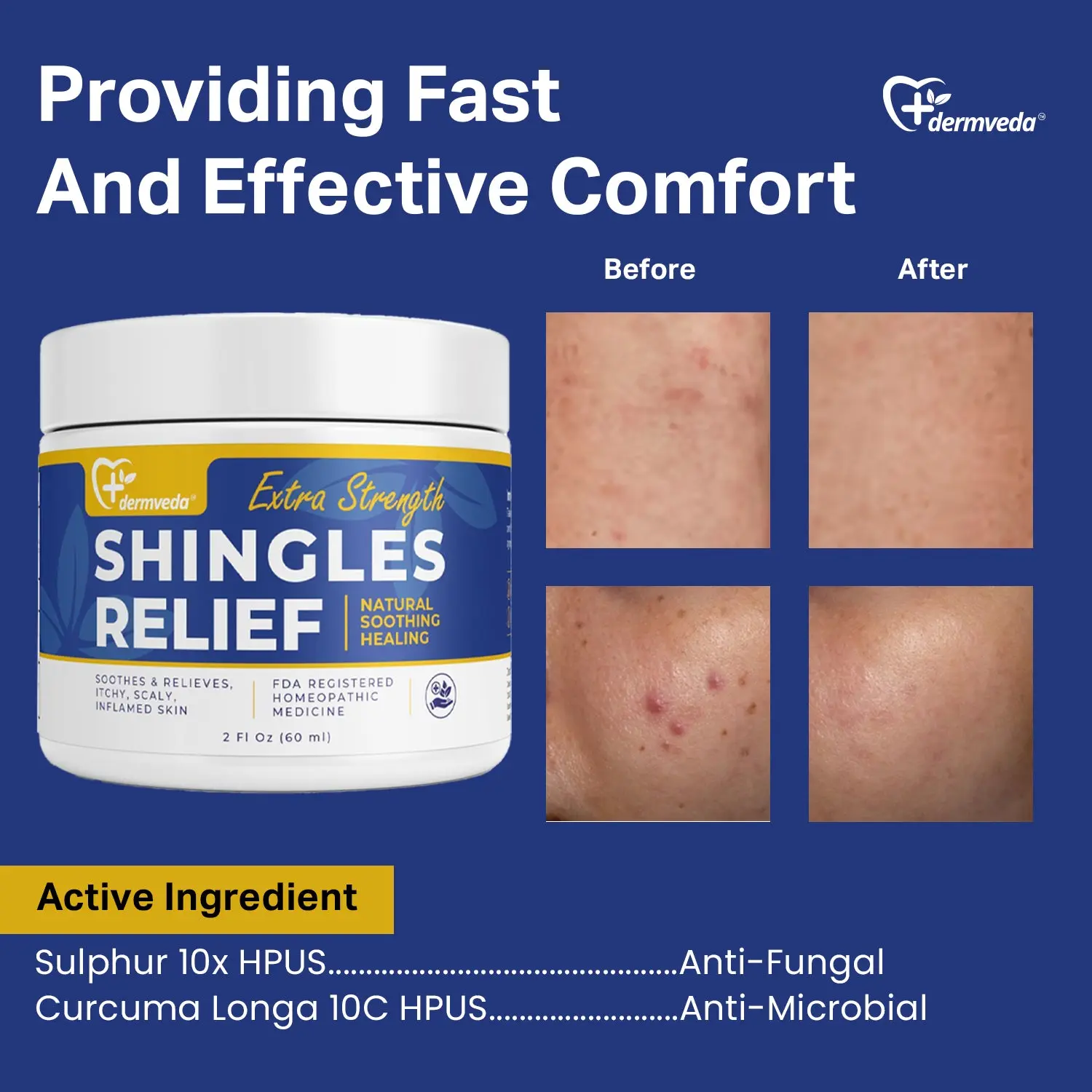 Shingles Rash Treatment Relief Cream - TikTok Shop