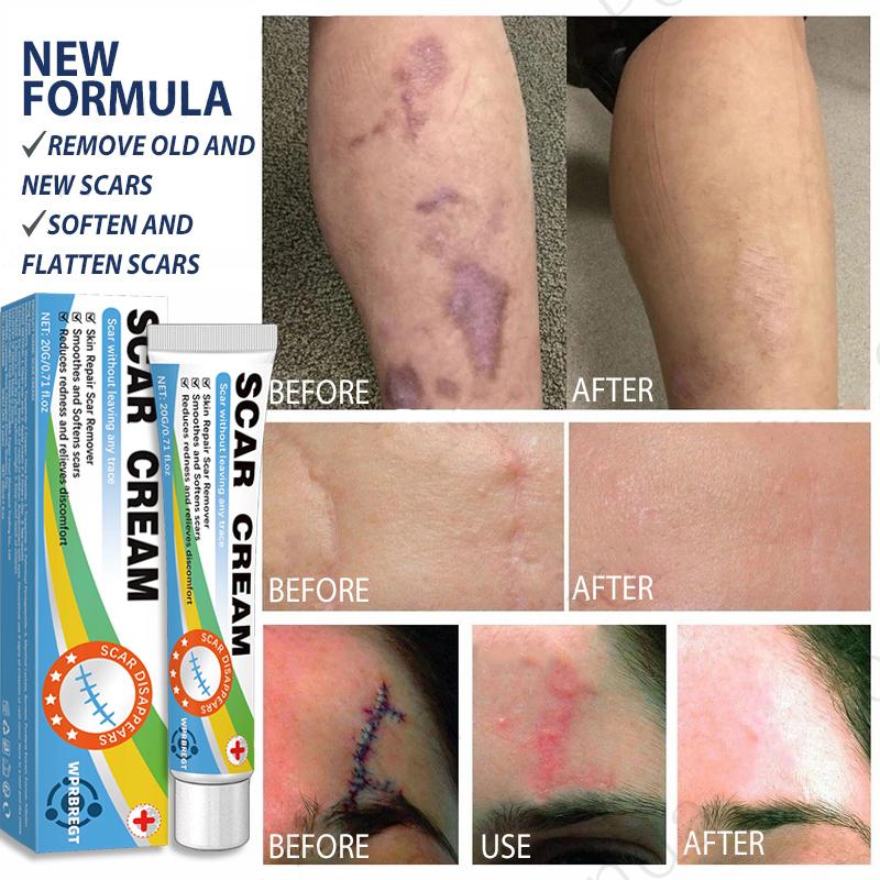 Scar Removal Cream & Gel for Effective Scarring Reduction - Fades Surgical & Acne Scars, Promotes Cell Regeneration, Lightweight Texture, Suitable for All Skin Types
