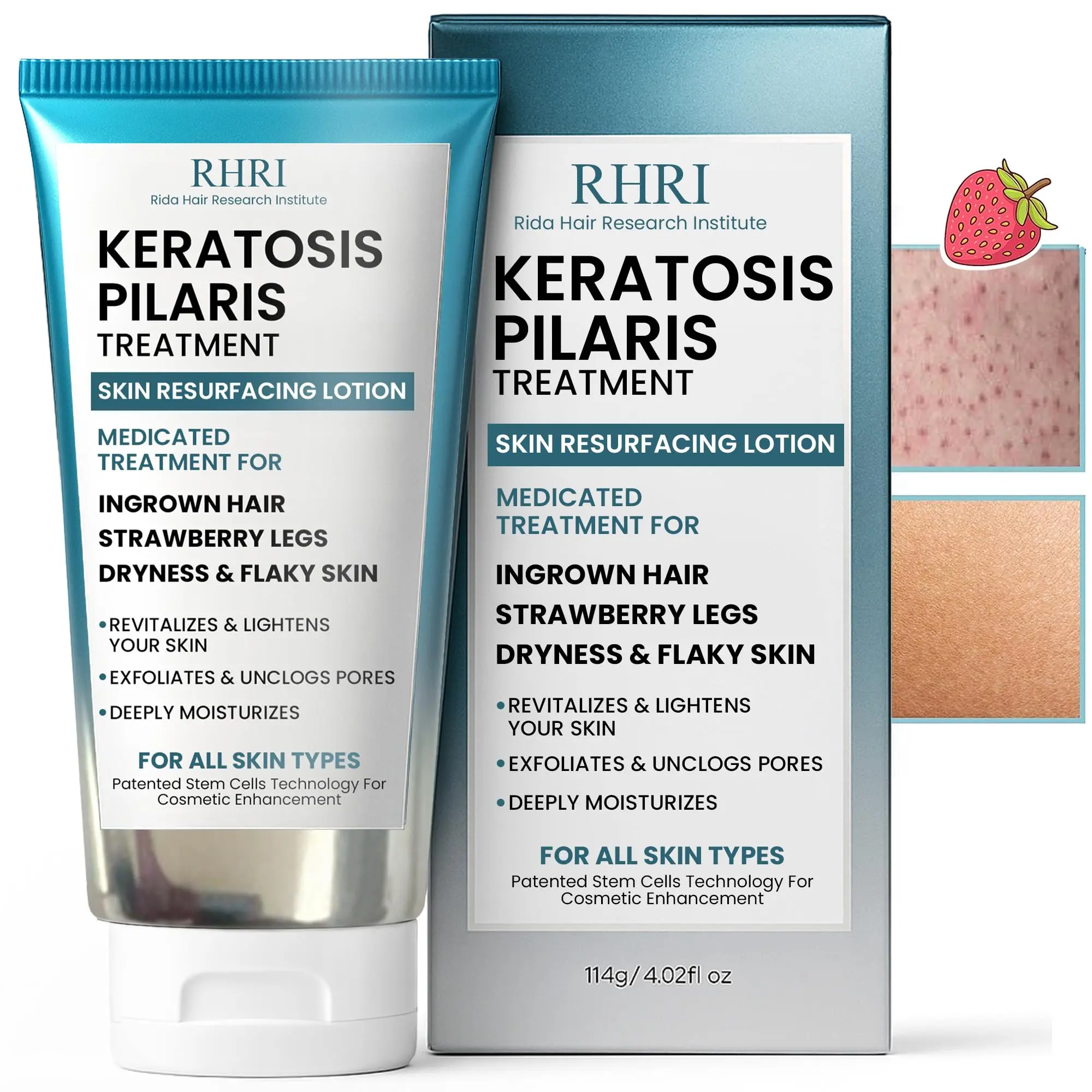 Keratosis Pilaris Treatment | Keratosis Pilaris Lotion with 10% AHA | Gentle Exfoliation For Strawberry Legs, KP & Ingrown Hairs | Smooth & Hydrating Body Lotion For Redness, Dry, Rough And Flaky Skin