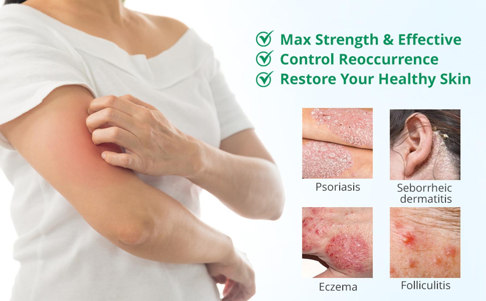 SanNuo Psoriasis & Eczema Cream - Natural Herbal Ointment for Itch Relief, Dry Skin & Sensitive Skin - Soothing & Hydrating Treatment - 30g  body glaze Therapeutic  Healthy