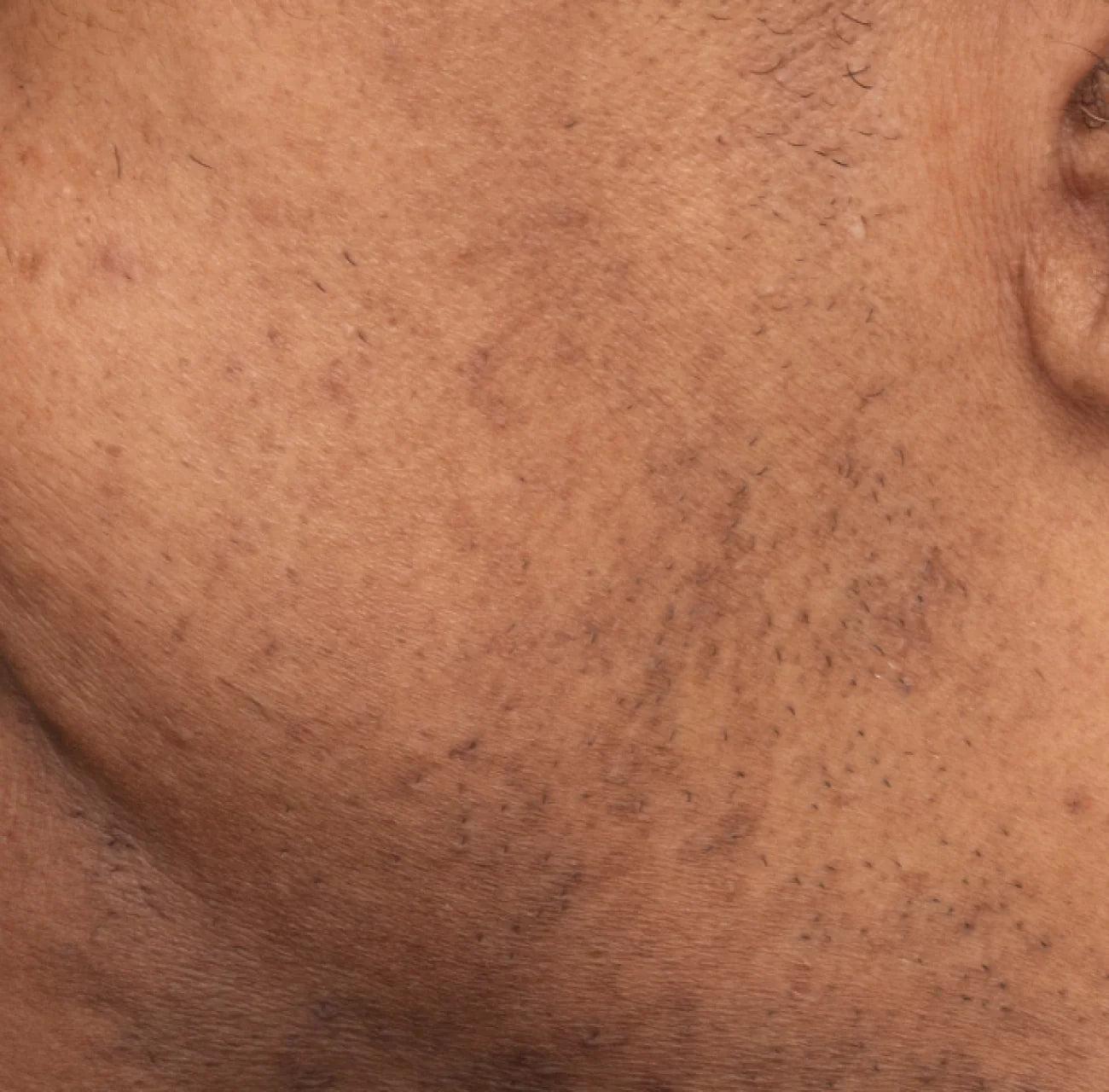 Major Fade Discoloration Duo - Daily Serum & Vitamin C Hydrating Moisturizer for Fading all Types of Discoloration