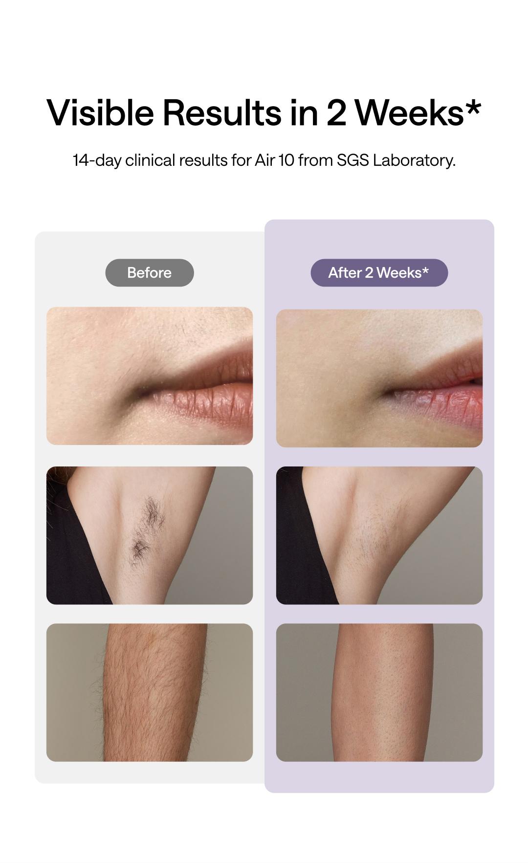 Ulike Laser Hair Removal, Air 10 IPL Hair Removal Device with Ice Cooling Comfort, Dual Lights, Skin Sensor & SHR Mode for Women & Men, Long-Lasting & Salon-liked Hair Removal Nearly Painless Result at Home, Christmas Present