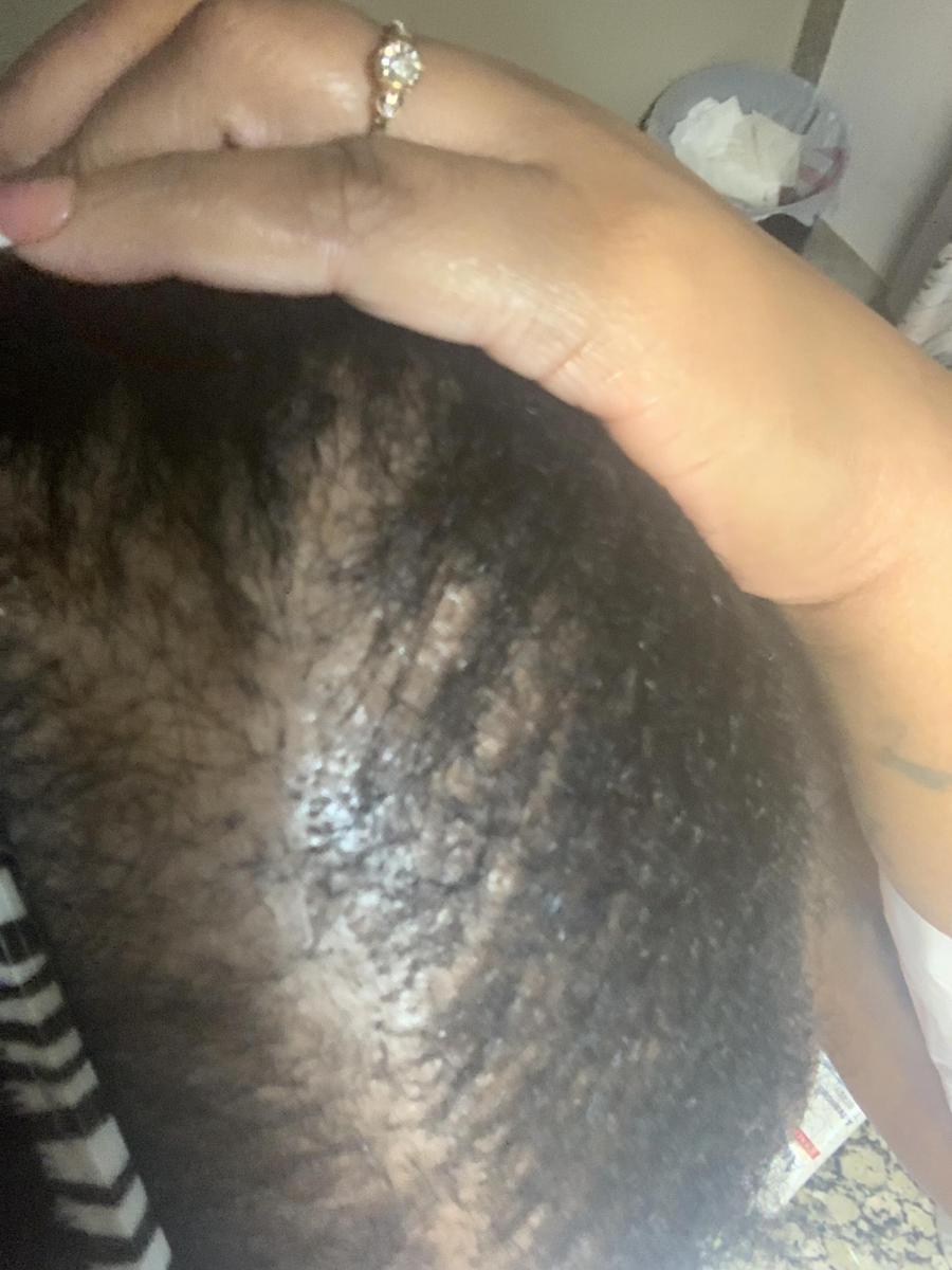 Item: 3 Bottles + 1 Derma Roller